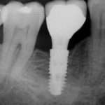 Kdaj so zobni implantati dobra odločitev